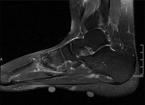 MRI with contrast; right foot—sagittal view.
