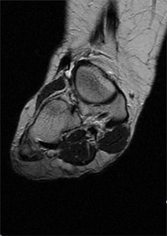 MRI with contrast; right foot—T2 coronal view.