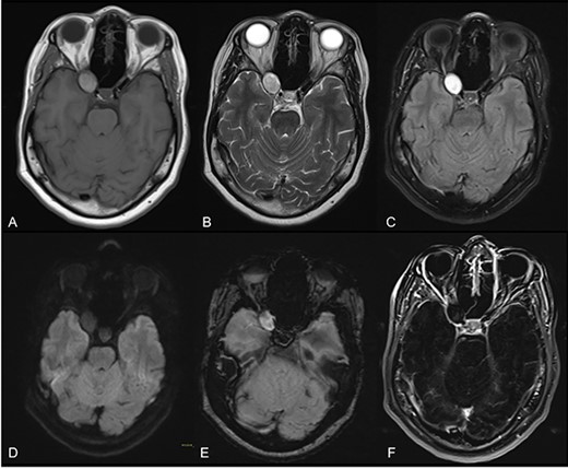 Axial cuts of brain MRI. T1W (A), T2W (B), FLAIR (C), DWI (D), SWI (E) and contrast-enhanced T1W images with subtraction (F); a rounded mass in the right ACP with intrinsic T1 high-intensity signal, suggesting a proteinaceous content with smooth, linear and peripheral mucosal enhancement; no restricted diffusion or susceptibility artifacts were observed.