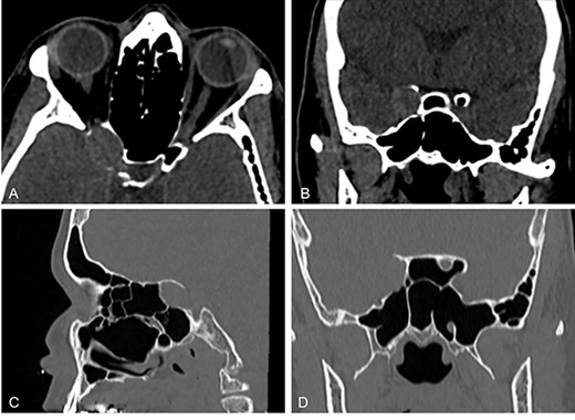 Paranasal sinus CT scans multiplanar reconstructions in axial (A), coronal (B, D) and sagittal (C) planes, with modified window (A and B) and bone algorithm (C and D); they show the right ACP with thin eroded walls, occupied by an oblong, soft tissue density mass that expands the bone cortical and compresses the right orbital apex.