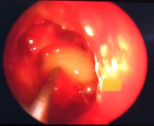 Grayish soft tissue lesion occupying the right ACP consistent with mucocele.