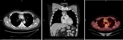 CT chest axial (left), coronal (middle) and PET (right) of invasive thymoma.