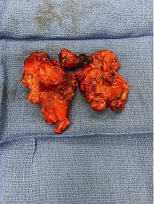 Post resection thymoma with en bloc resection of SVC.