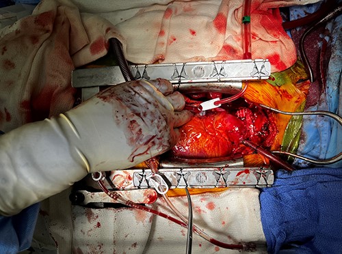 SVC with Gore-Tex graft reconstruction.