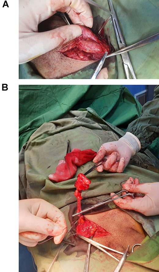 (A) Inflamed appendix in inguinal sac (Amyand’s hernia). (B) Appendix extracted from inguinal hernia.