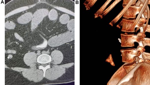 (A) Abdominal CT, revealing a foreign body in the lumen of the bowel. (B) CT reconstruction of the foreign body.