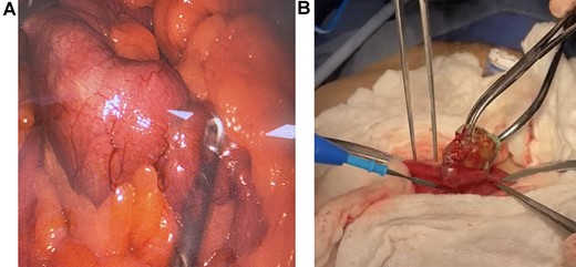 (A) Laparoscopy, the foreign body is found in the bowel. (B) Extraction of the foreign body through enterotomy.