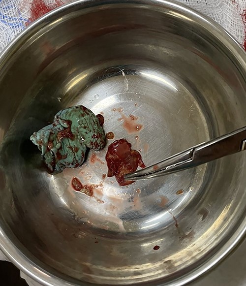 Alginate dental mold.