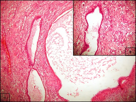 (a) Multiple cysts of varying sizes separated by septa; flat epithelial cells lining the cysts, and there is no atypia or mitosis (H/E x400); (b) cysts separated by hypercellular stroma (H/E x100).