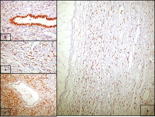 (a) PR positivity in the stromal spindle cells (PR x400), and (b) strong nuclear PAX8 positivity in epithelial cells (PAX8 x100); (c) high power view of 2a (PR x100); (d) CD10 positivity in the stromal spindle cells, concentrated around epithelial elements (CD10 x100).