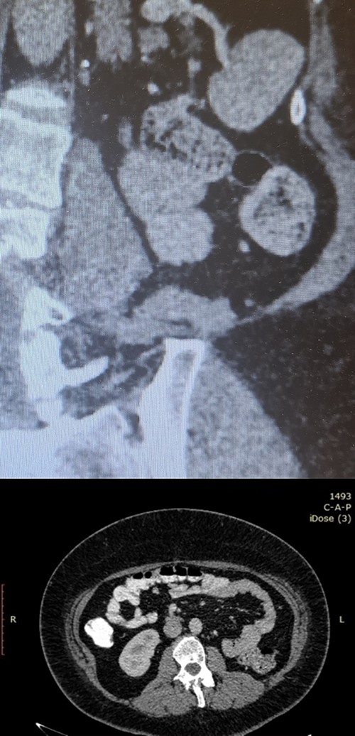 Postoperative follow-up imaging with abdomen CT at 12 months; coronal (upper side) and axial (lower side) planes, and no evidence of local recurrence, and no other pathologic finding.