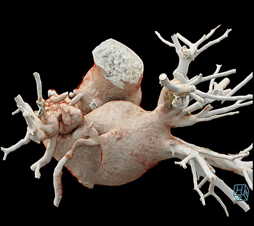 3D reconstruction of anastomosis of pulmonary vein to left atrial appendage.