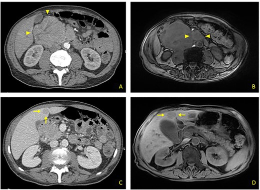 (A) Contrast CT scan: bulky formation with inhomogeneous uptake, arising from upper duodenal-pancreatic angle (arrowheads). (B) MRI: main lesion appears hypointense on fat-suppressed T1-weighted sequences. Evidence for further retromesenteric contrast enhanced tissue (arrowheads). (C) Contrast CT scan: hypodense rounded liver metastasis arising from segment V, measuring 2.5 cm in diameter (arrows). (D) MRI: T1-appearance of subglissonian pericholecystic liver metastasis (arrows).