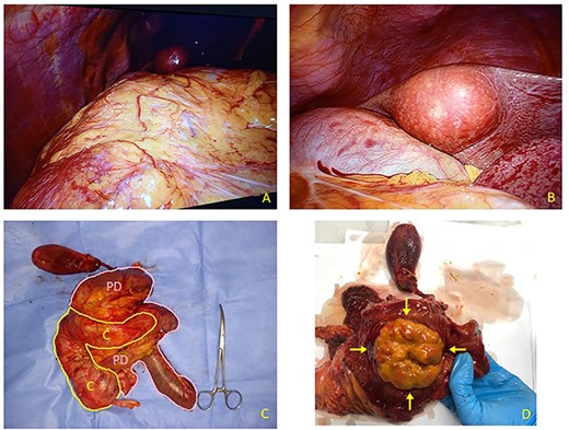 (A) Laparoscopic appearance of voluminous mass occupying right flank and hypochondrium. (B) Laparoscopic view of round-shaped pericholecystic liver metastasis. (C) Resected specimen includes right colon (C) and Whipple pancreatoduodenectomy (PD). Liver specimen has been examined separately. (D) After duodenal section, evidence for large rounded mass arising from descending pre-ampullary duodenal part (arrows).