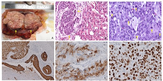 (A) Resected specimen: cut surface appears as firm, fleshy and pink to grey in color (arrows). (B) Hematoxylin and eosin staining. Morphological aspect of polygonal cells with oval nuclei, rounded nucleoli and abundant pale cytoplasm. Evidence for alveolar growth pattern (arrows, 20× magnification). (C) High-degree NET (G3) evidence for several mitotic figures (arrows) Mitotic Index: >20 × 2 mm2 (40× magnification). (D) IHC duodenal slide showing diffuse positivity for CK7 (10× magnification). (E) IHC slide showing diffuse positivity for chromogranin A (40× magnification). (F) IHC slide demonstrating a strong staining for Synaptophysin (40× magnification).