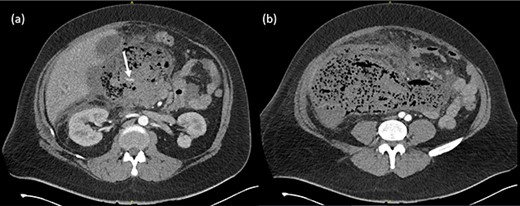 (a) Arterial phase CT axial view demonstrating peripancreatic collection with extensive gas loculations and active arterial blush (white arrow). (b) Extensive peripancreatic collection at the level of the aortic bifurcation.