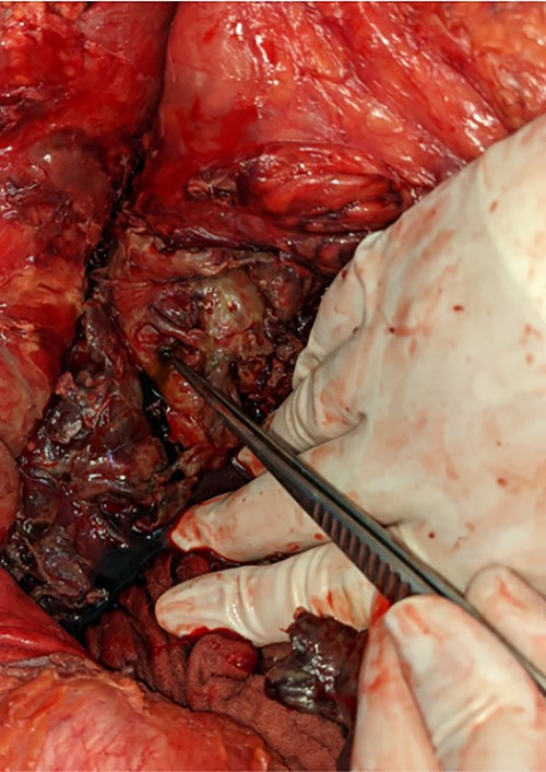 Duodenal ulcer identified by forceps.