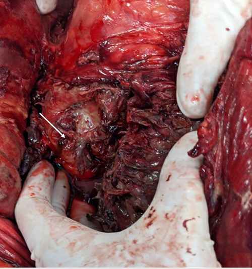 Duodenal ulcer (white arrow) with adjacent pancreatic tissue.