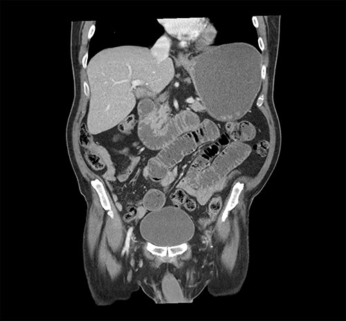 CT of the abdomen and pelvis showing evidence of small bowel obstruction with dilated stomach and loops of the small intestine.