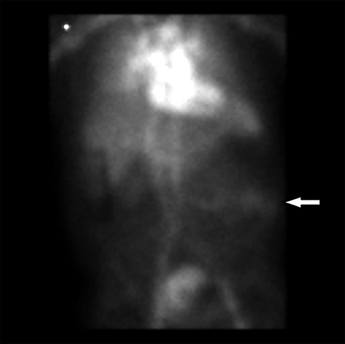 Radionuclide RBC scan showing active hemorrhage within the mid-small intestine (arrow).