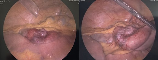 Laparoscopic images of melanoma metastasis in the mid-jejunum.