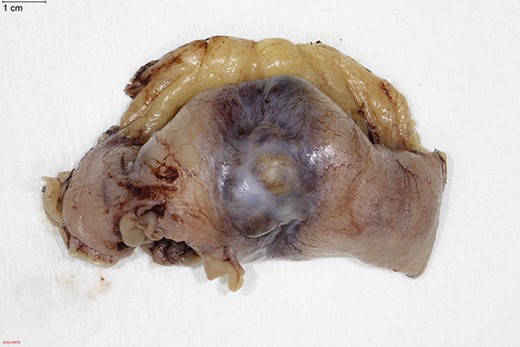 Resected portion of jejunum containing an obstructing melanoma metastasis.