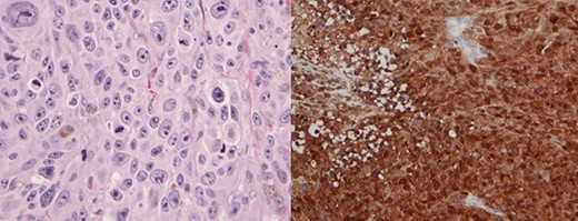 Histology slides showing nests of pleomorphic tumor cells with prominent nucleoli and cytoplasmic pigment (left); positive immunostaining of S-100 protein consistent with malignant melanoma (right).