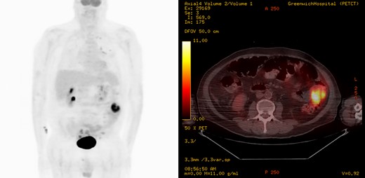 Coronal and axial images of a positron emission tomography showing high metabolic activity in the small intestine within the left lateral abdomen.