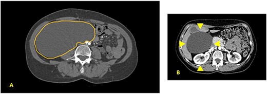 (A) Contrast CT scan; gross oval-shaped mass with clear fluid content (10–15 HU) and regular margins, measuring 15 × 10 cm in maximum diameters; (B) evidence of liver and gallbladder compression (arrowheads).