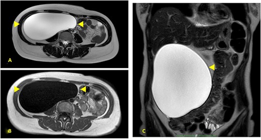 (A) Prohance® MR; main lesion appears hyperintense on T2-weighted sequences (arrowheads); (B) main lesion appears hypointense on T1-weighted sequences (arrowheads); (C) coronal T2-weighted sequences confirmed main radiological findings: size 15 × 20 cm, thin aspect of envelope, absence of infiltrative aspect and gross displacement of surrounding structures.