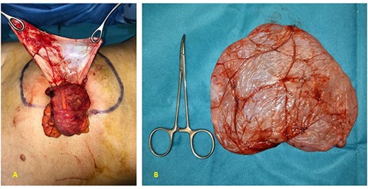(A) At operative setting, cyst has been empty of its content and partially dissected from ascending colon; (B) macroscopical appearance of resected specimen: mesenteric cyst with thin and translucent envelope.