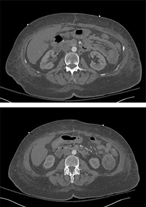 Intussusception of the proximal small bowel on CT abdomen without contrast.