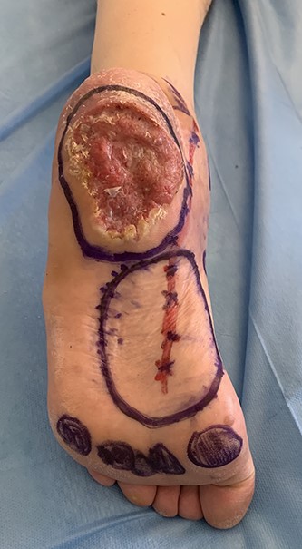 Preoperative picture of the SCC of the heel measuring 5.5 × 4.5 cm, and preoperative markings of the flap. Vessels were marked on the skin with the assistance of a handheld 8-MHz Doppler ultrasound scanner.