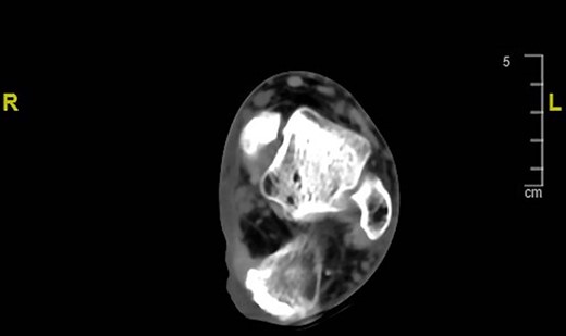 Preoperative CT scan of the left foot showing the lesion strictly close to the calcaneus.