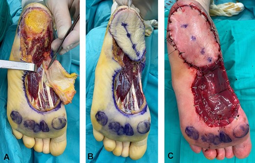 Intraoperative figures showing the defect after tumor excision, and the flap harvested with the medial plantar artery indicated by the forceps (A). Flap coverage of the heel defect (B). Immediate postoperative appearance; the donor site was covered with a meshed Integra® Dermal Regeneration Template (C).