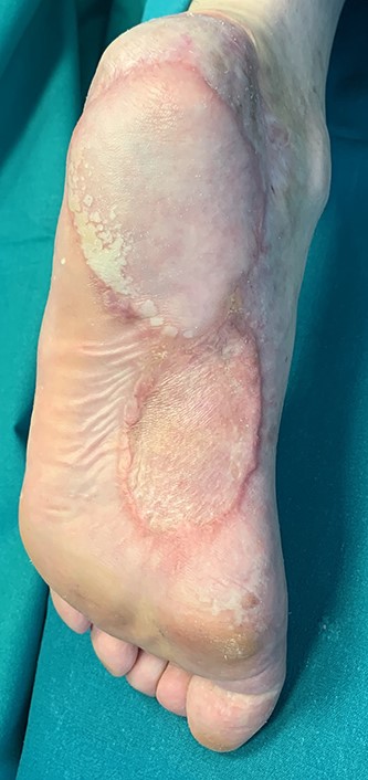 Eighteen-month follow-up picture showing no ulceration or tumor recurrence, an excellent anatomical contour and a satisfactory aesthetic result.