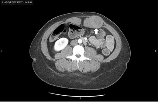 Contrast-enhanced CT scan demonstrates a mass within the left rectus sheath.
