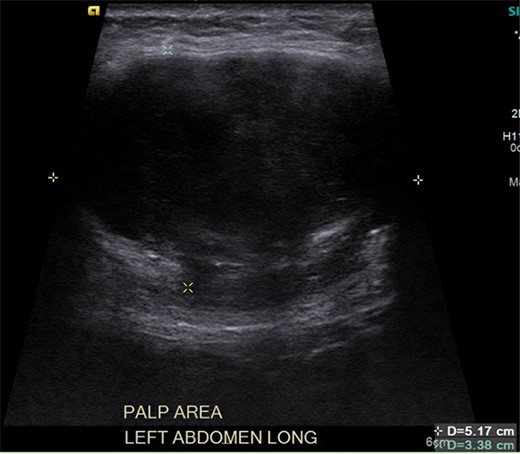 Ultrasound reveals an enlarged solid mass with internal vascularity.