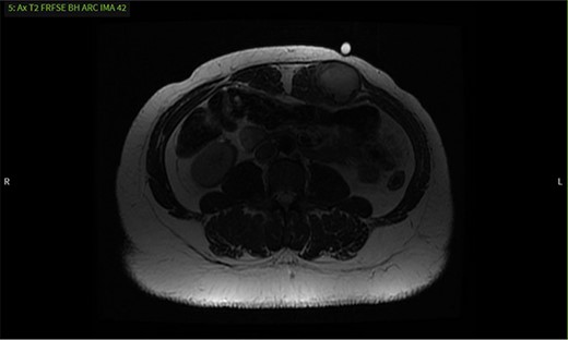 MRI shows a mass with well-defined margins and high signal intensity on T2 sequence.