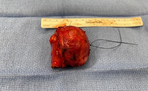 Gross specimen macroscopically shows a well-defined mass measuring 5.4 × 4.7 × 4.8 cm.