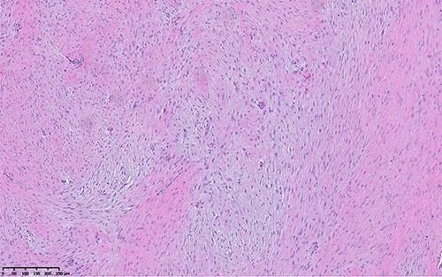 Hematoxylin and eosin image shows hypocellular lesion with long sweeping fascicles of bland spindle cells in background of collagenous and myxoid stroma.