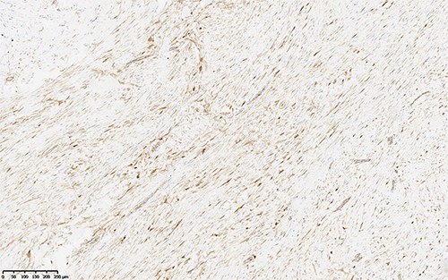 Immunohistochemistry performed for B-catenin shows strong nuclear staining, indicating molecular alteration in CTNNB1 gene. Without the mutation, we see cytoplasmic staining.