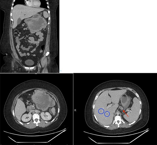 Initial CT scan showing large epigastric mass originating from the greater curvature of the stomach. Red arrow indicates large necrotic lymph node. Blue circles indicate liver metastases.