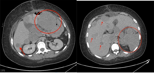 One-month post-operative follow-up CT scan showing progression of disease with large metastatic deposits (indicated by the red circles and arrows).