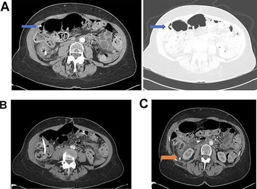(A) Distal biliary stent perforation of the ascending colon at the level of the hepatic flexure (as indicated by arrows). (B) Stent migration at the level of the ascending colon. (C) Dislodged bile duct stent with perforation into the retroperitoneum at the level of the cecum (as indicated by arrow).