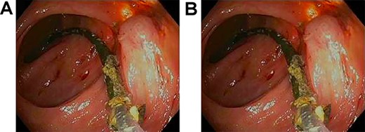 (A) Ascending colon demonstrating ulceration and the biliary stent lodged within colonic wall. (B) Stent across transverse colon with punctate erythema.