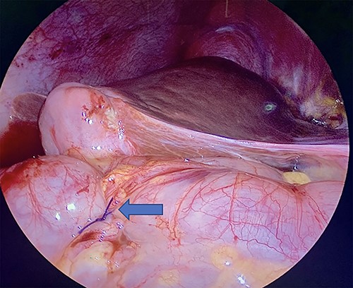 Laparoscopic visualization of a serosal lembert suture placement on transverse colon (as indicated by arrow; ascending colon serosal repair not featured).