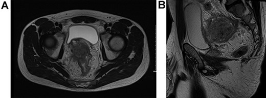 T4BN2MX Upper rectal cancer (A) axial view and (B) sagittal view.