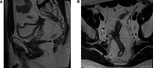 Post total neoadjuvant therapy (A) axial view and (B) sagittal view.
