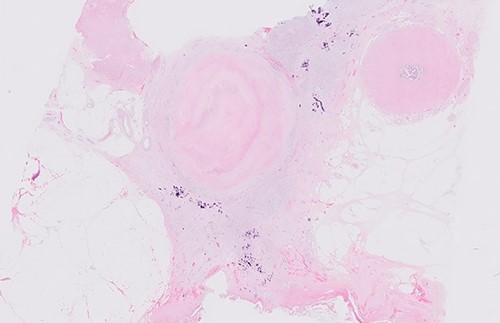 Postoperative histology.